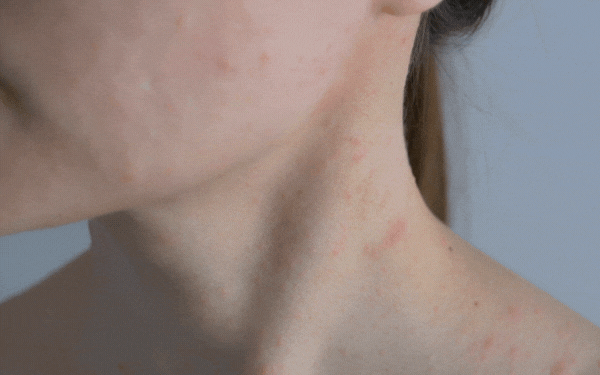 Allergic Reactions